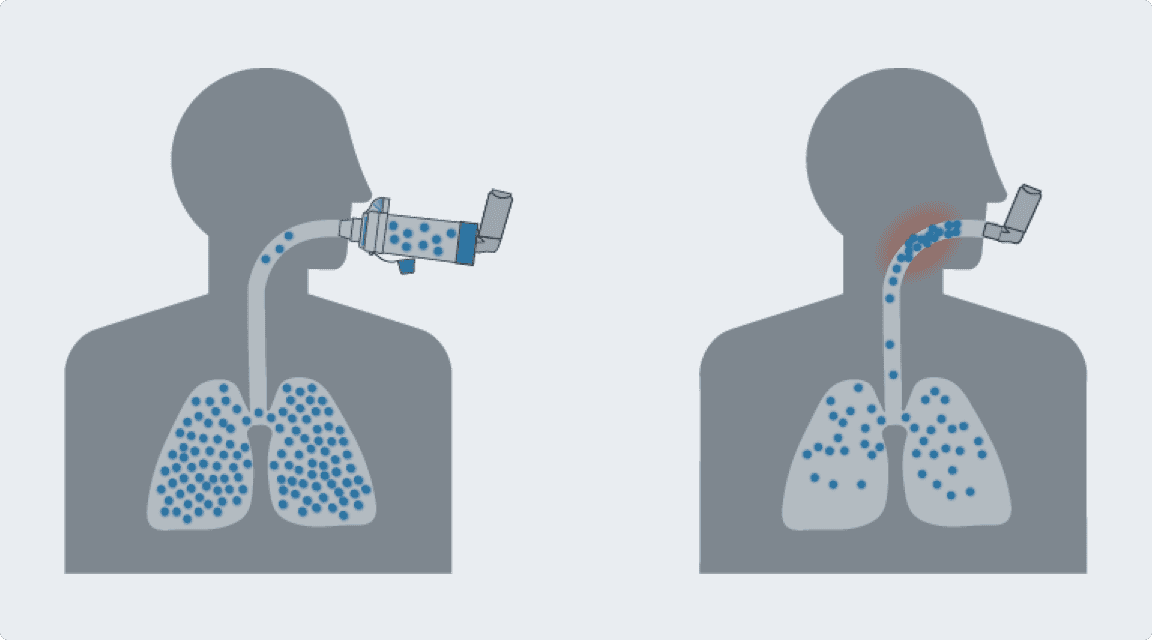 Texte de remplacement pour l’image de comparaison du dispositif Ventolin